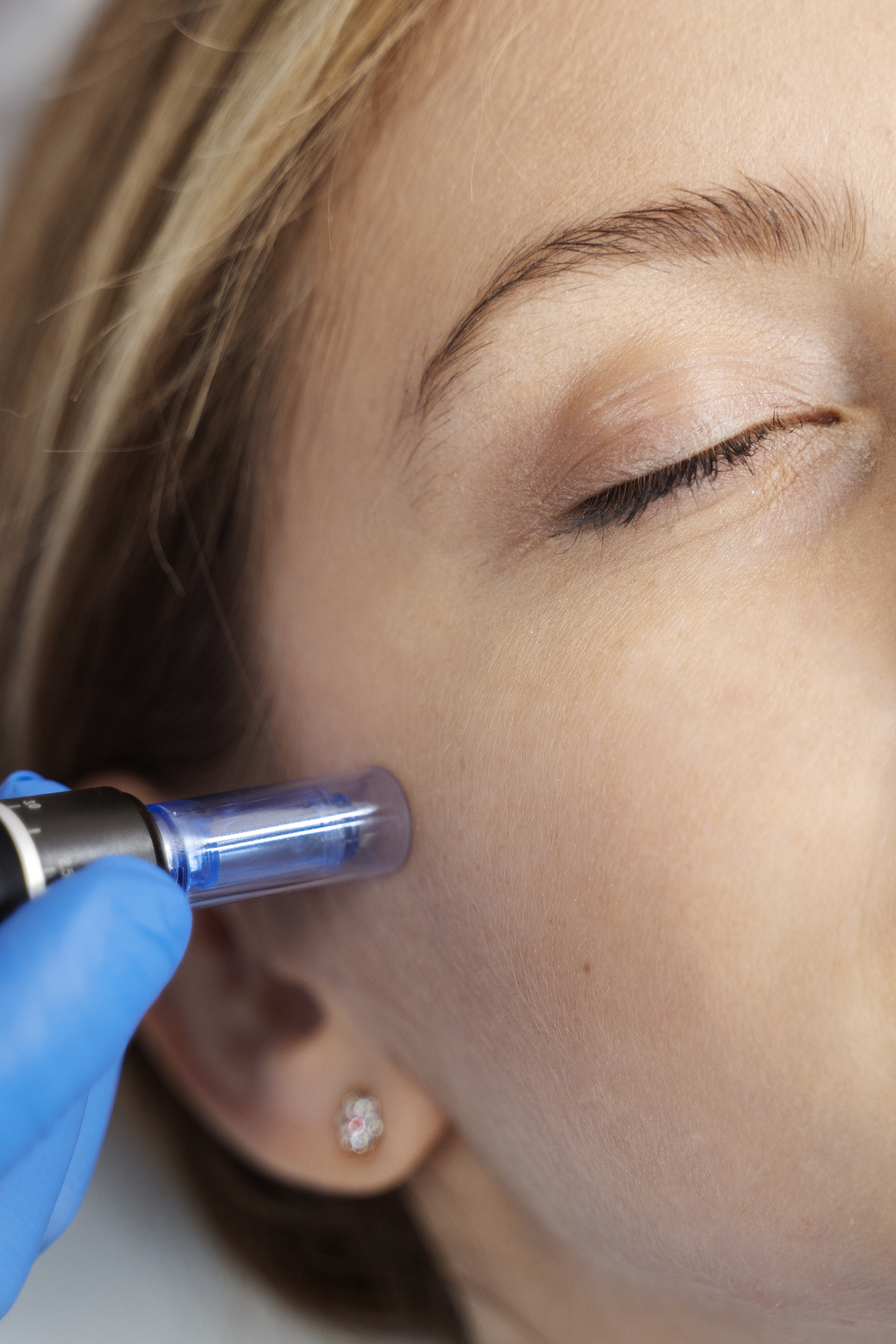 Dermapen facial
